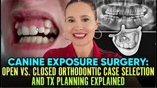 Open vs Closed Impacted Canine Exposure Surgeries with Braces or Invisalign