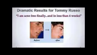 Best Acne Treatment - Acne No More Product Review