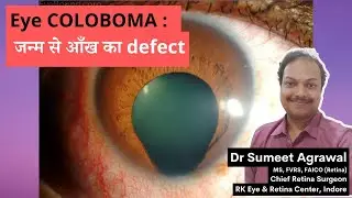 Eye Coloboma: A common birth defect of the eyes