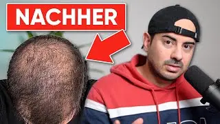 Minoxidil zerstört Haartransplantation Ergebnis | Haarpigmentierung soll ihn retten