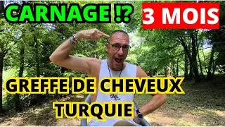 🇹🇷 GREFFE de CHEVEUX 3 MOIS après (raté? Loupé? ) sans minoxidil et sans finasteride avec klineva