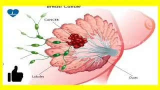 Breast Cancer Symptoms | Symptoms Of Breast Cancer | Signs Of BREAST CANCER