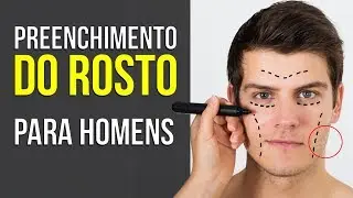 Preenchimento de Mandibula e Malar em Homens | Rosto Masculino | Dr Erlacher