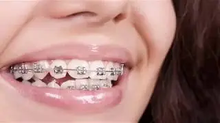 Braces | Newark NJ - Child Smiles