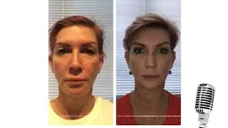 Jodi's breast implant removal with fat transfer
