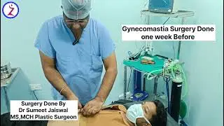 Gynecomastia Surgery Day 7 After Surgery . Delhi Mumbai Bangalore Chandigarh kolkata Indore Surat