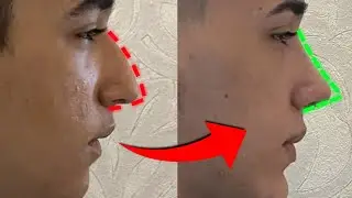 How to Get a Straight, Sharp Nose Tip Naturally