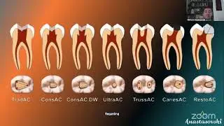 Top-notch Root Canal Shaping and Obturation