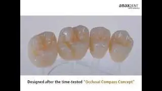 Introducing Hans - anaxdent's implant denture tooth