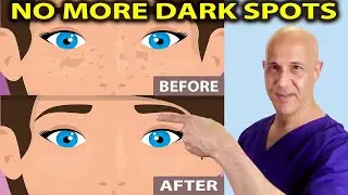 Brighten Your Skin:  How to Lighten Dark Spots with Everyday Ingredients!  Dr. Mandell