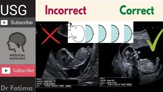 CRL vs MSD Which is More Accurate for Early Pregnancy Ultrasound?