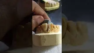 Technique rapide pour couronne provisoire proth&egrave;se dentaire