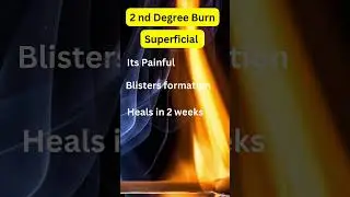 What are 3 Degrees of burn #burn #burninjuries #burn classification