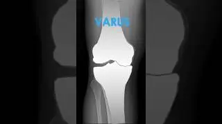 Varus - Valgus Deformities of the Knee on X-Ray #kneepain #radiology #anatomy