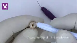 Step by Step EndoHandle System