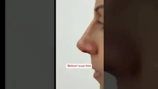 Nose filler transformation in East London #filler #nosefiller #nosefillerlondon