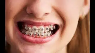 free braces treatment Dr r ahamed dental hospital karvana kliye jankari kliye video ko jarur dekhe