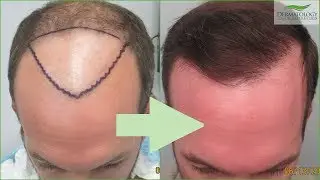 FUE Hair Transplant UPDATE - Los Angeles - Before and After