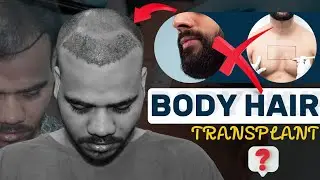 Hair Transplant Body Hair To Head | হেয়ার ট্রান্সপ্লান্ট বডি হেয়ার টু হেড বাংলায়
