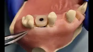 Powerbone Flexible Graft onlay in peri-implant defect