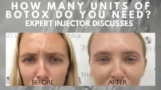 How Many Units of Botox Do You Really Need? Expert Injector Reveals the Secret Formula!