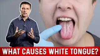 What Causes White Tongue? &ndash; Dr.Berg on Oral Candidiasis