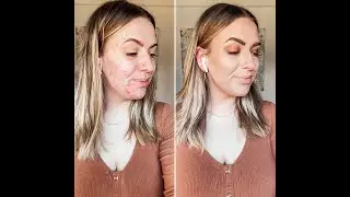 How I cover my hormonal acne with my iiid foundation // SEINT BEAUTY