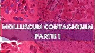 LE MOLLUSCUM CONTAGIOSUM (partie 1) - PATHOLOGIE
