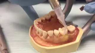 Placing Arestin