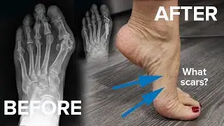 Minimally Invasive Bunion Surgery - A patient story | West Valley Hospital