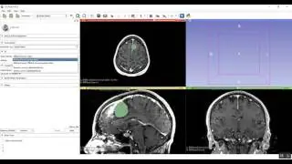 Segmentation & 3D Model Construction using 3D slicer