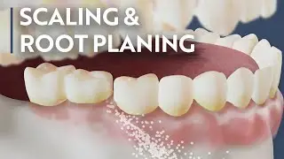 Why a Deep Cleaning is Different from Your Routine Dental Visit