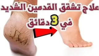 خلطة مجرّبة لإزالة تشقق القدمين وترطيبها بعمق بمكونات بسيطة