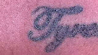 Closeup - How Plasma Tattoo Removal Works.