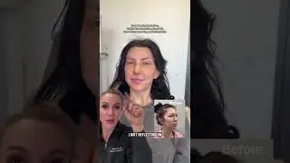 Brow Bossing Reduction, Brow Lift, Blepharoplasty| 6 Days Post op| Facial Plastic Surgery