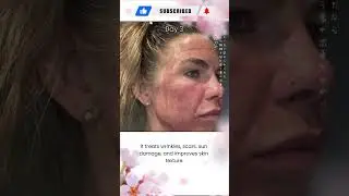 HELIX CO2 Laser: Advanced Skin Resurfacing with Faster Healing & Stunning Results