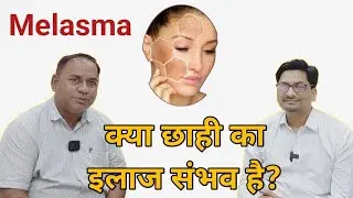 Melasma Podcast: Without Coffee with Ravi छाही का इलाज और आने वाली मुश्किलें, कैसे ठीक करें #melasma