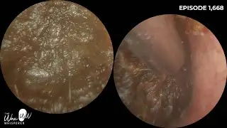 1,668 - Ear Wax Removal in Patient With Healed Eardrum Perforations | Endoscopic Procedure