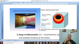 Trauma in Arabic 52 ( Burns , part 2 ) , by Dr. Wahdan