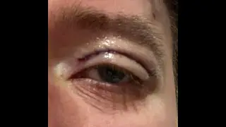 They Operated On My Eye to Blade Runner Music🔪👁️🌧️Johnny Massacre LONDON VLOGーCheeky Live Stream 182