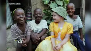 Health &ndash; Albinism
