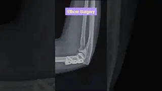 Elbow💪 Surgery