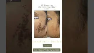 Birth Mark Removal without any surgery or scar @drroopamsskinaceaskinclini2808