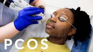 Laser Hair Removal for Women with PCOS