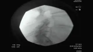 Fluoroscopic lumbar epidural injection lateral contrast spread