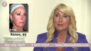 All About the Non-Surgical Y-Lift Procedure | The Skin & Vein Center