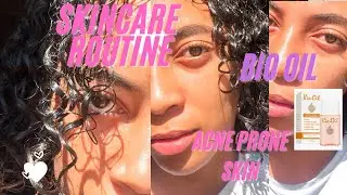 How I cleared my acne prone skin with Bio Oil | +EXTRA tips