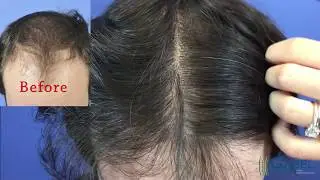 Dr Steven Gabel Hair Transplant   3655 Grafts