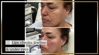 Dermal filler for Denver Botox GATTONI Medical Aesthetics