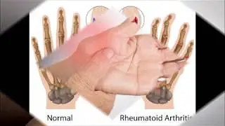9 Best exercises for rheumatoid arthritis pain